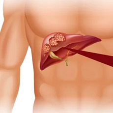 Liver cancer profile
