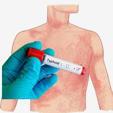 Typhoid Profile